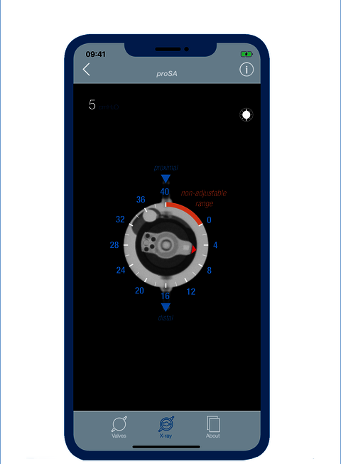 Screenshot der Hydrocephalus MIETHKE App – die Röntgenansicht zeigt, wie die Druckstufen der MIETHKE Shunts im Röntgen aussehen, für ein leichtes Ablesen der Shunt Einstellung im Röntgen.