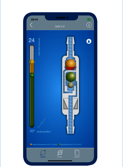 Screenshot der Hydrocephalus App MIETHKE App – ein Blick ins Innere der MIETHKE Shunts zeigt den Fluss durch das Ventil für ein besseres Verständnis der Funktionsweise.