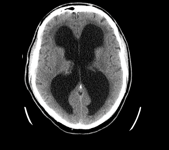 MRT vom Gehirn, Unterdrainage, Hydrocephalus