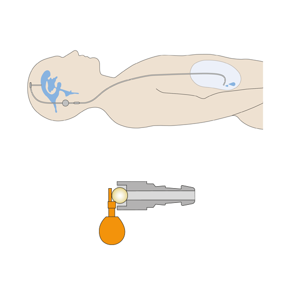 Horizontale Position proSA Shunt Querschnitt und Patient